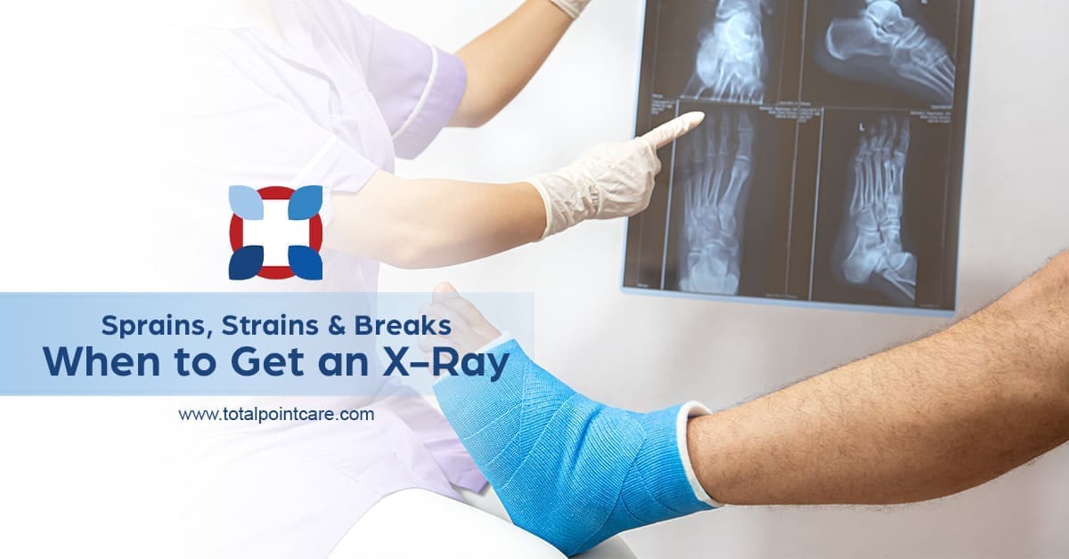 Sprains, Strains & Fractures: When to Get an X-Ray