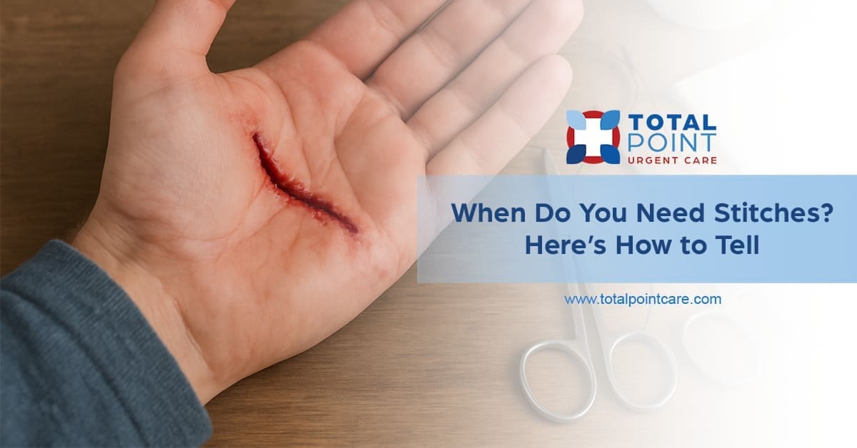 When Do You Need Stitches? Here’s How to Tell