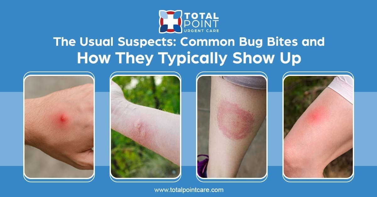 The Usual Suspects: Common Bug Bites and How They Typically Show Up