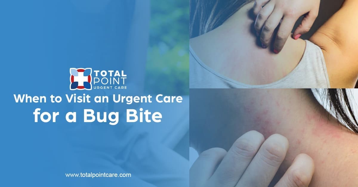 When to Visit an Urgent Care for a Bug Bite