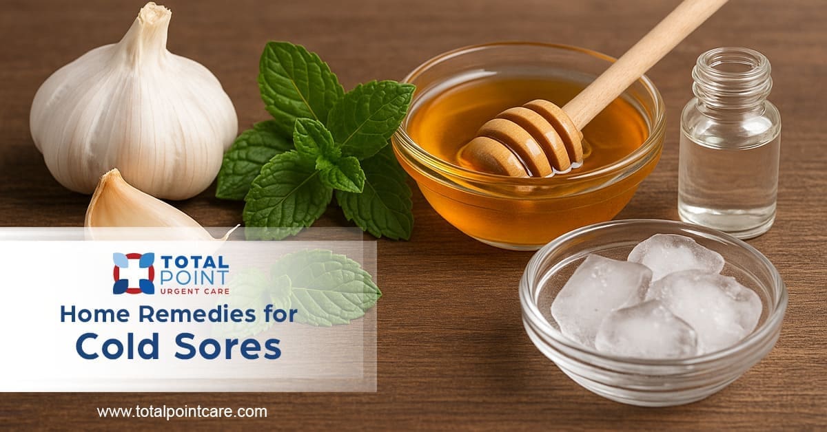 Home Remedies for Cold Sores