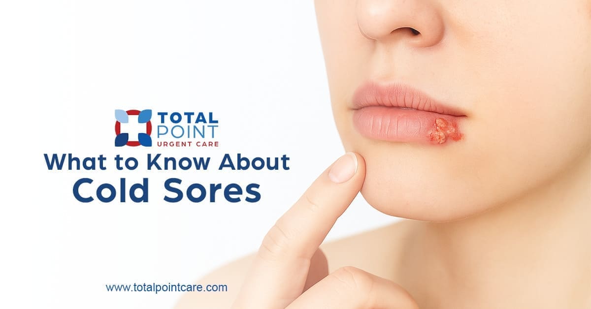 What to Know About Cold Sores