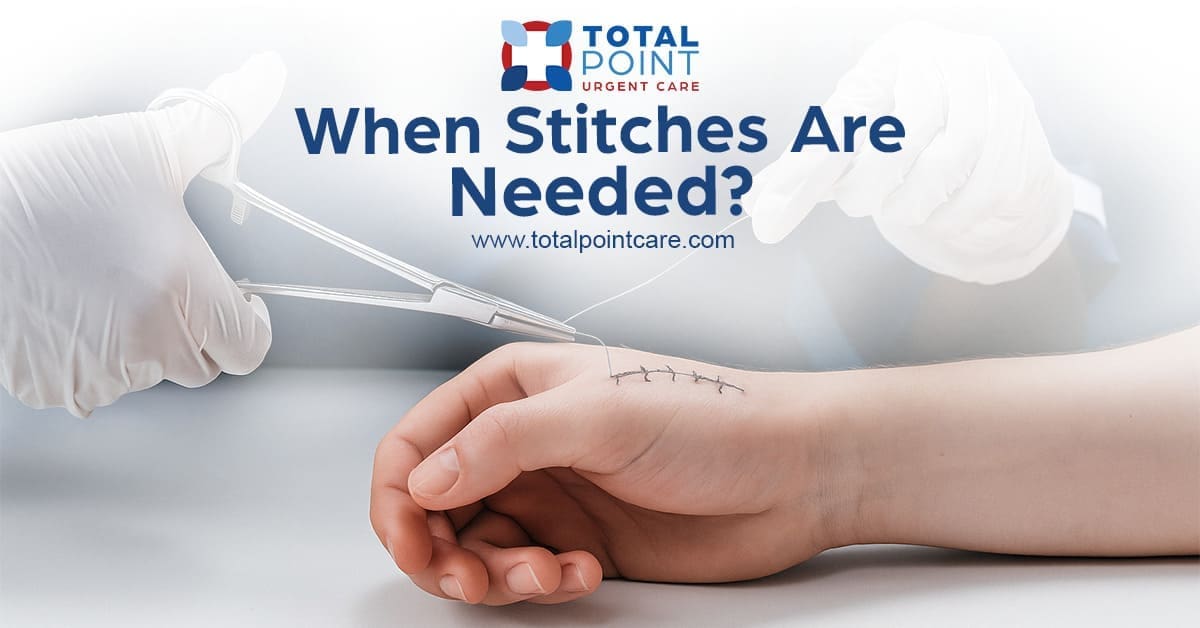 When Stitches Are Needed?
