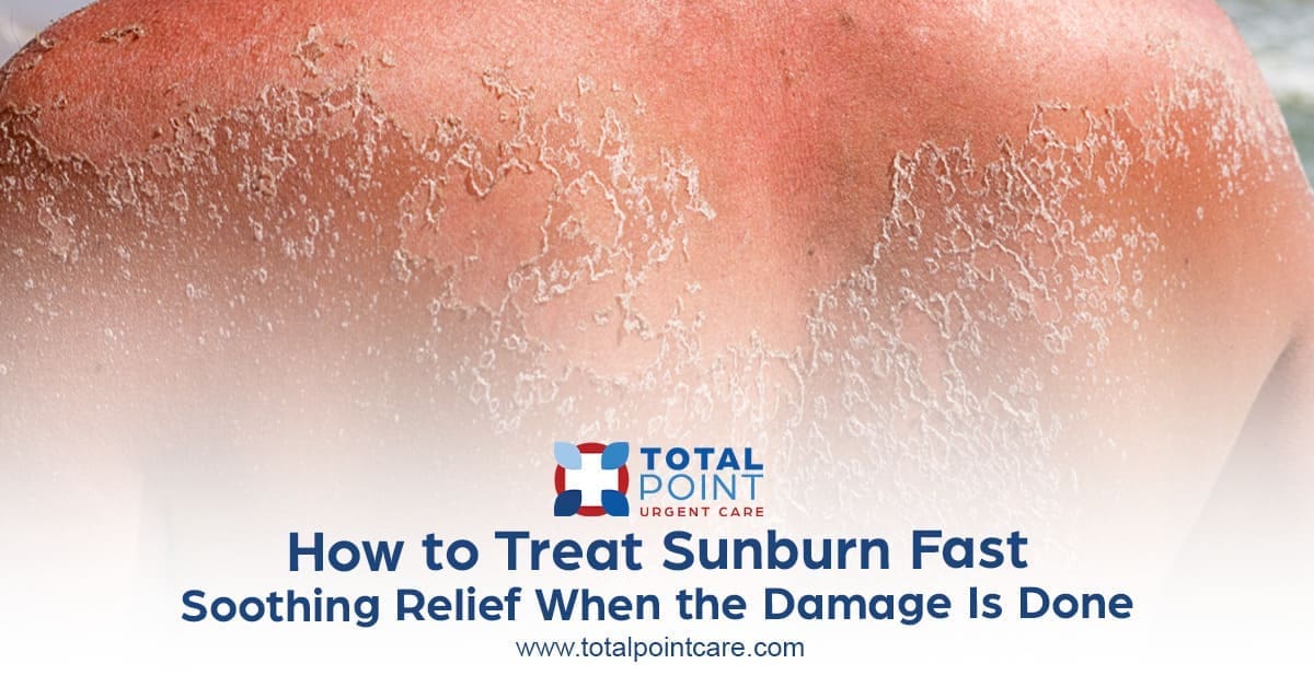 How to Treat Sunburn Fast: Soothing Relief When the Damage Is Done