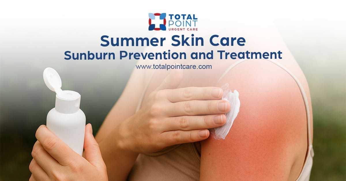Summer Skin Care: Sunburn Prevention and Treatment