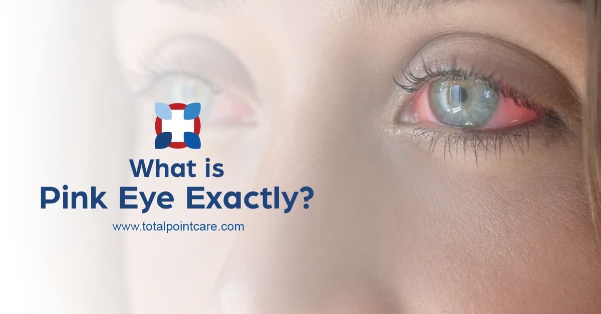 What Is Pink Eye, Exactly