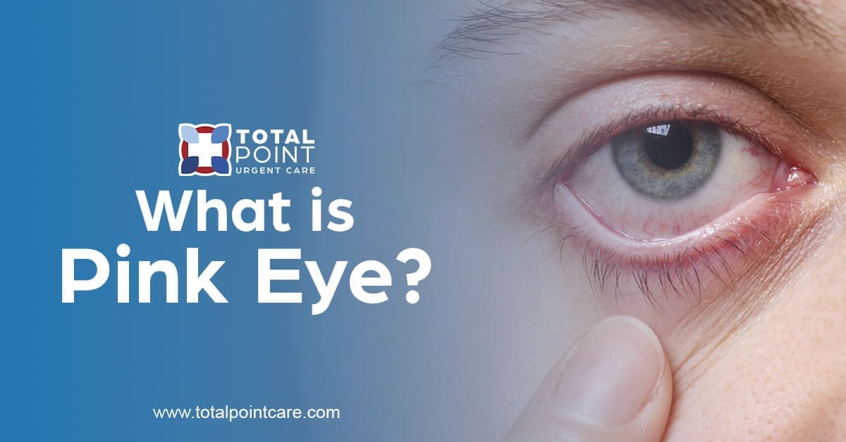 What is Pink Eye? Symptoms, Causes, and When to See a Doctor
