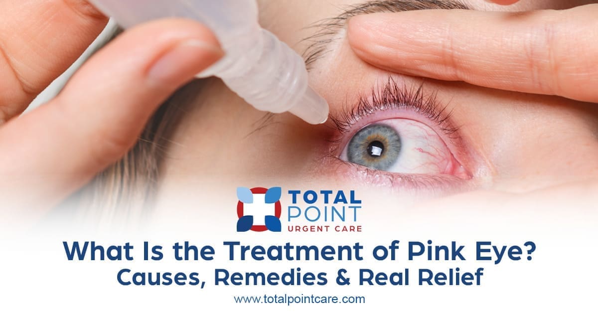 Treatment of Pink Eye – How to Manage Viral, Bacterial, and Allergic Conjunctivitis